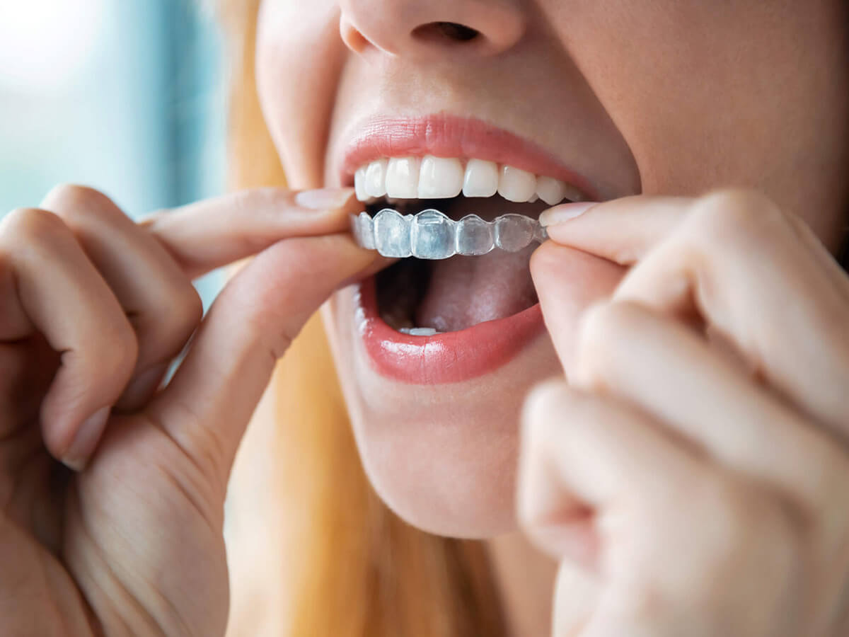 clear aligner upper teeth A close-up of a woman inserting a clear aligner onto her upper teeth, showing the process of wearing orthodontic treatment for teeth alignment.